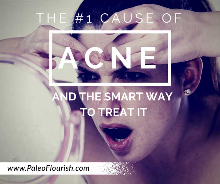 The #1 Cause of Acne and the Smart Way to Treat It https://paleoflourish.com/the-number-1-cause-acne-smart-way-treat/